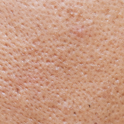 acne breakout